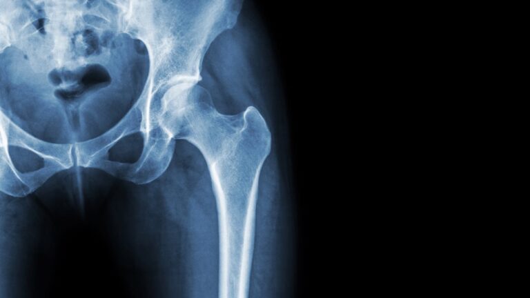 Beyond calcium: Tips for building strong and healthy bones